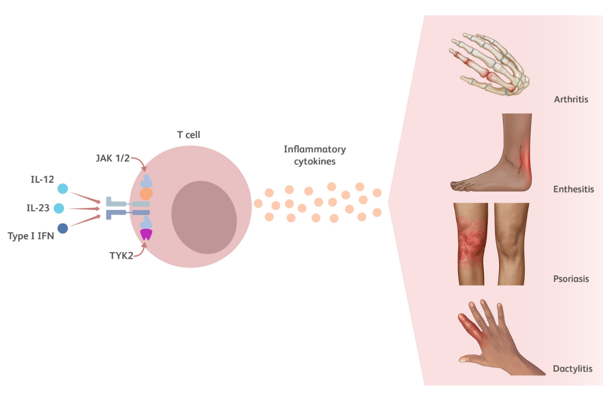 TYK2-mediated Pathophysiology of Psoriatic Arthritis